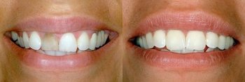 Smile Gallery - Ogden Valley Dental, Naperville Dentist