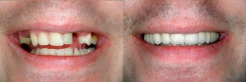 Smile Gallery - Ogden Valley Dental, Naperville Dentist