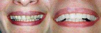 Smile Gallery - Ogden Valley Dental, Naperville Dentist