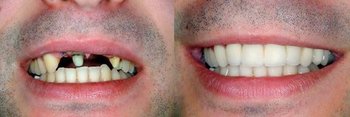 Smile Gallery - Ogden Valley Dental, Naperville Dentist