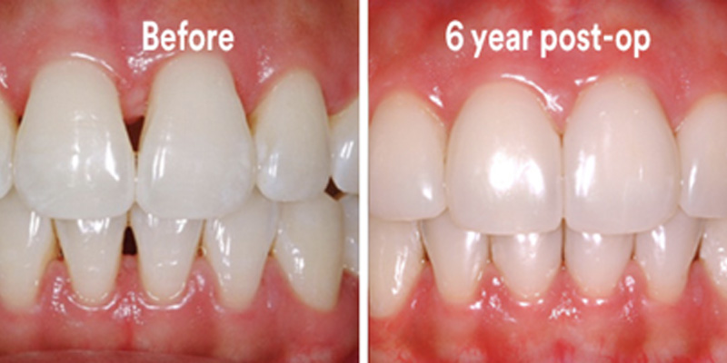 BioClear Diastema Closure and Black Triangle Closure  - Ogden Valley Dental, Naperville Dentist