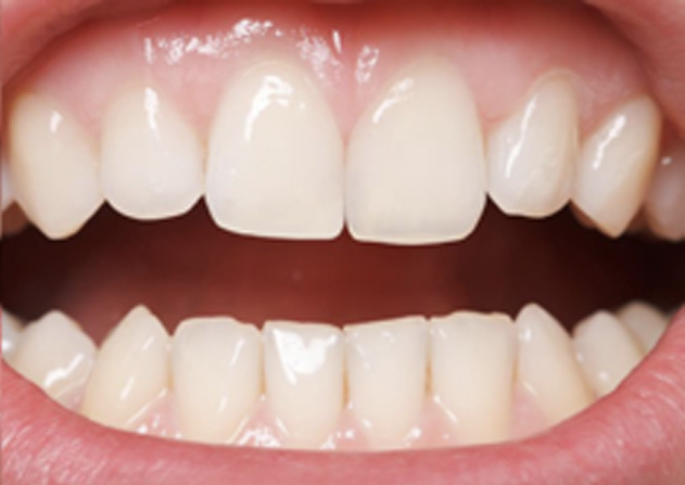 Cosmetic Bonding  - Ogden Valley Dental, Naperville Dentist