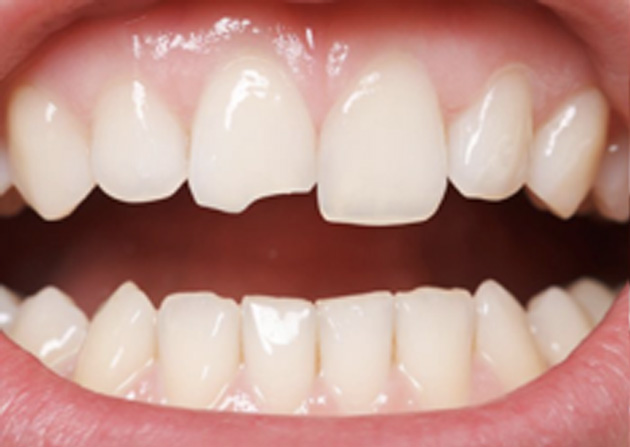 Cosmetic Bonding  - Ogden Valley Dental, Naperville Dentist