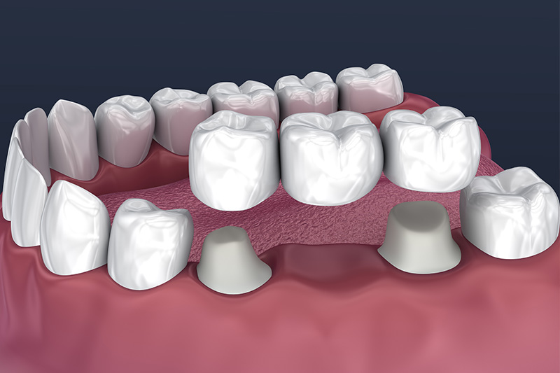Crowns and Bridges, Inlays and Onlays - Ogden Valley Dental, Naperville Dentist