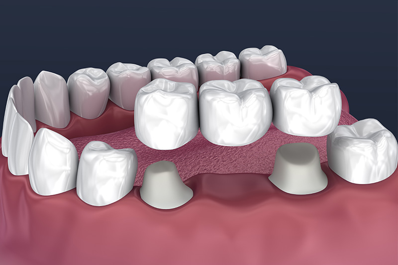 Crowns and Bridges, Inlays and Onlays  - Ogden Valley Dental, Naperville Dentist