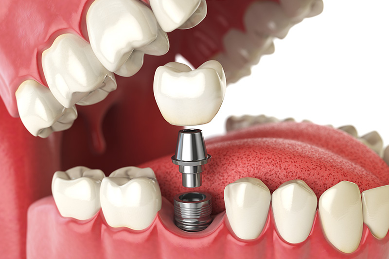 Dental Implants - Ogden Valley Dental, Naperville Dentist