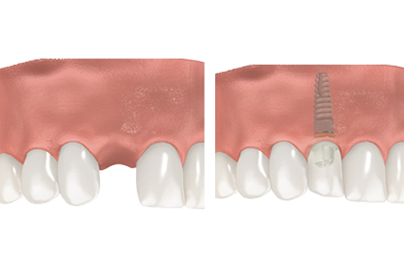 Dental Implants - Ogden Valley Dental, Naperville Dentist