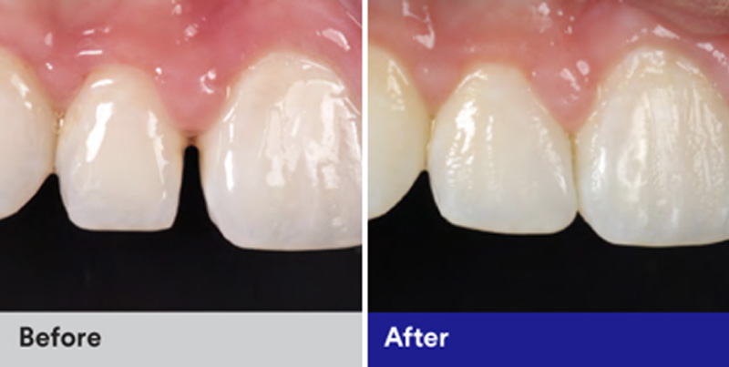 BioClear Diastema Closure and Black Triangle Closure  - Ogden Valley Dental, Naperville Dentist