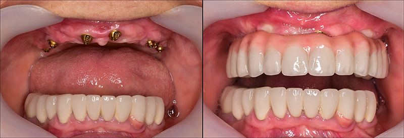 Implant Overdentures and Fixed All-On-X Treatment  - Ogden Valley Dental, Naperville Dentist