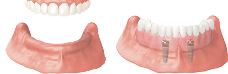 Implant Overdentures and Fixed All-On-X Treatment  - Ogden Valley Dental, Naperville Dentist