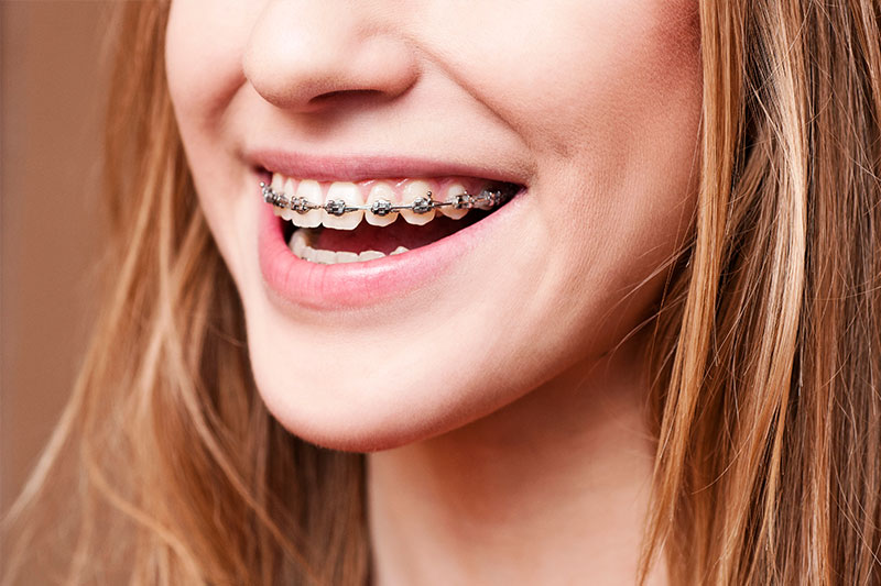 Orthodontics - Ogden Valley Dental, Naperville Dentist