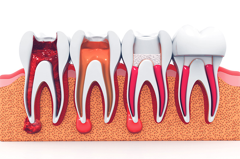 Terapia de Endodoncia - Ogden Valley Dental, Naperville Dentist
