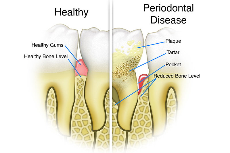 Scaling & Root Planings (Deep Cleanings) - Ogden Valley Dental, Naperville Dentist