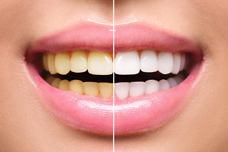 Teeth Whitening - Ogden Valley Dental, Naperville Dentist