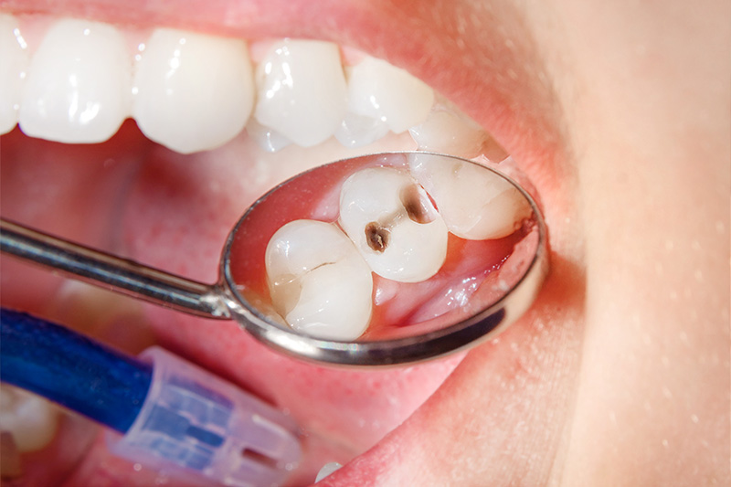 Tooth Colored Composite Fillings  - Ogden Valley Dental, Naperville Dentist