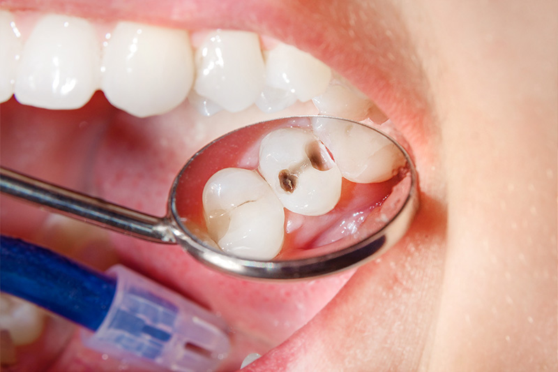 Tooth Colored Composite Fillings - Ogden Valley Dental, Naperville Dentist