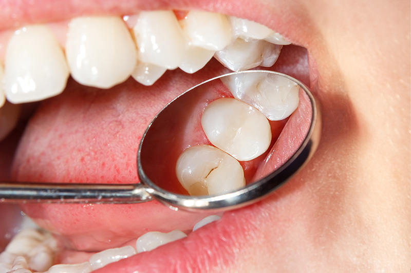 Tooth Colored Composite Fillings - Ogden Valley Dental, Naperville Dentist