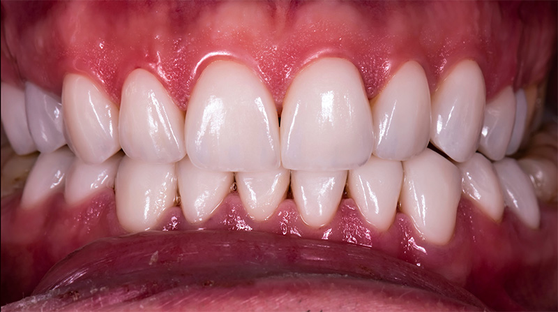 Veneers  - Ogden Valley Dental, Naperville Dentist