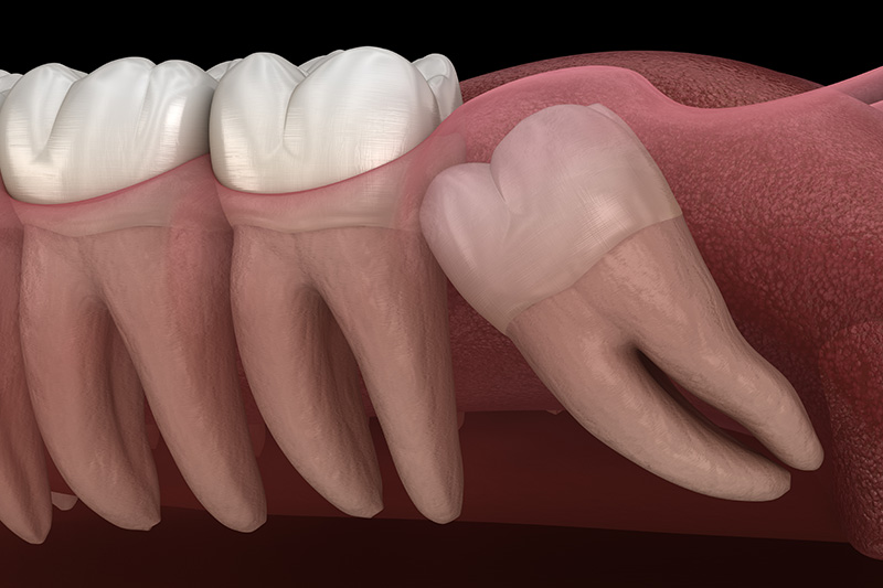 Wisdom Teeth Extractions (with Sedation)  - Ogden Valley Dental, Naperville Dentist