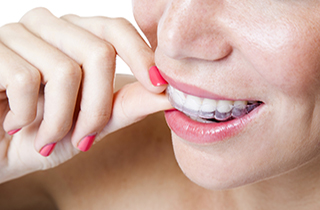 Invisalign - Ogden Valley Dental, Naperville Dentist
